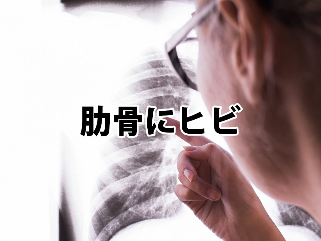 肋骨にヒビ